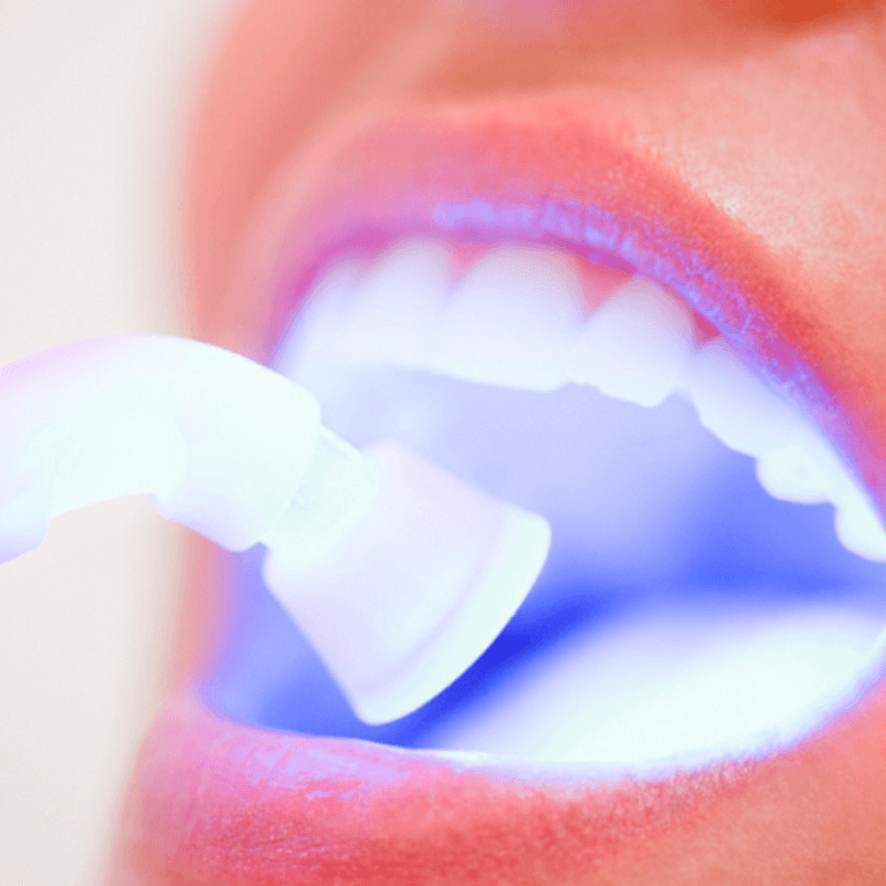 clareamento-dental-integra-odontologia-bertioga