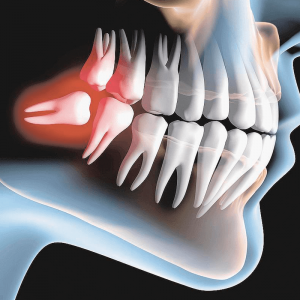 Tiro ou não tiro o dente do siso? - Integra Odontologia